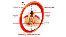what is endodontics