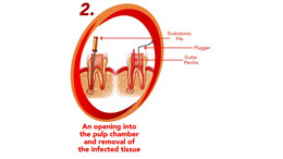 what is endodontics